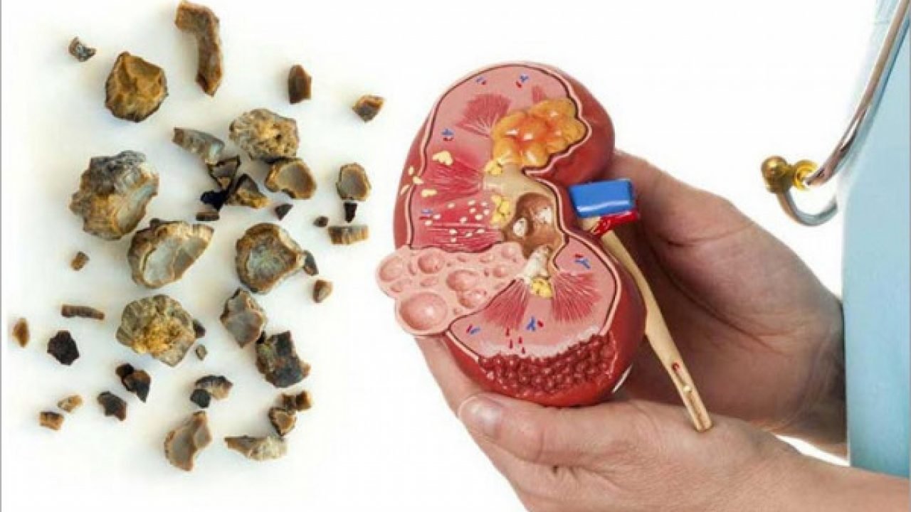 Gangguan Batu Ginjal Kini Banyak Menyerang Usia Produktif, Ini Peran Herbal Pendukung